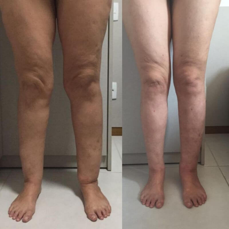 Résultat avant après LymphCare™