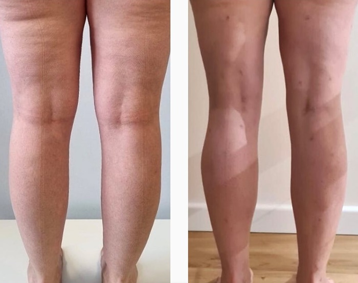 Résultat LymphCare™